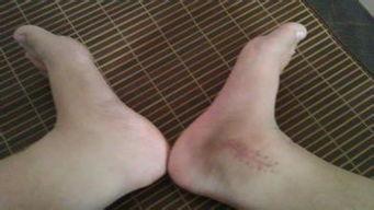 脚骨折后可以吃茭瓜吗,茭瓜的适宜摄入与禁忌